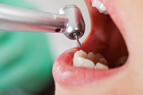 Best Emergency Tooth Extraction in East Bethel, MN